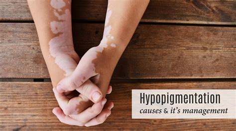 Hypopigmentation | what its causes, symptoms and management – Dr.JRK's ...