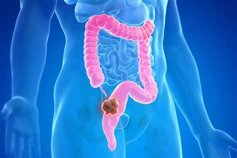 Image result for Colon Cancer Surgery Procedure