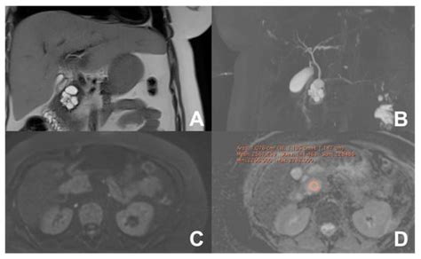 Imaging of the Liver and Pancreas: The Added Value of MRI