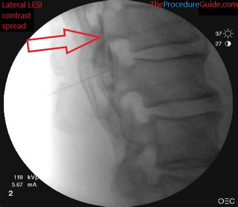 Image result for Shoulder Injection Fluoroscopy