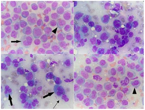 Non Epitheliotropic B-Cell Lymphoma with Plasmablastic Differentiation ...