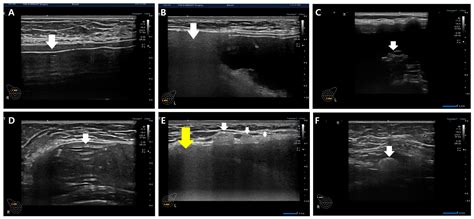 Exploration of Point-of-Care Ultrasonography for Silicone Breast Implant Rupture Detection and ...