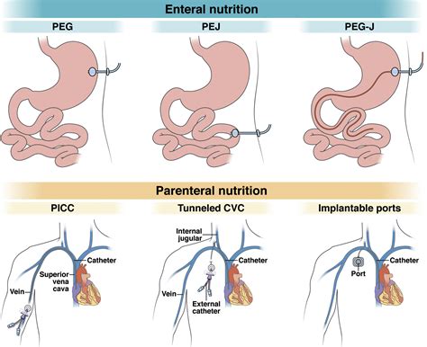 How to Approach Long-term Enteral and Parenteral Nutrition ...