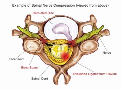Image result for Nerve Root Block Lower Back