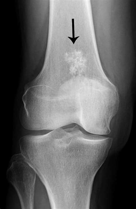 Worrisome and Incidental Signs on Knee Radiographs in Clinical Practice ...