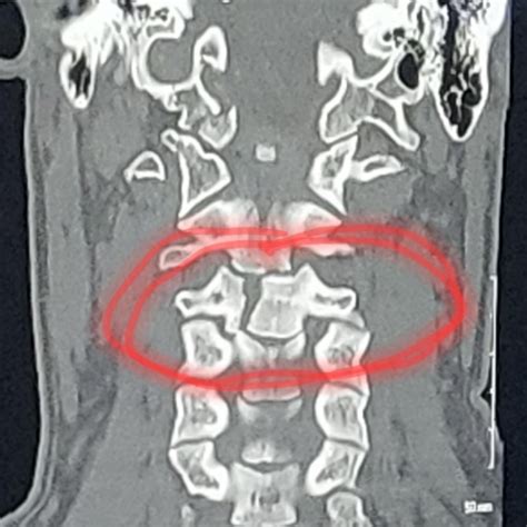 Radiology at my hospital: “No acute abnormality identified.” : r ...