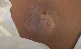 Image result for Painful Giant Abscess Exploding