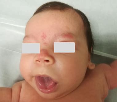 Macroglossia: the importance of genetic testing for prognosis ...