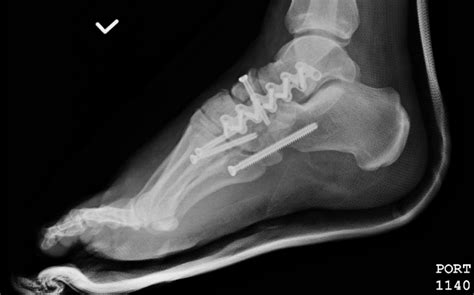 Temporary bridge plating of the medial column in Chopart and Lisfranc ...