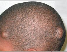 Image result for Epidermoid Cyst Scalp