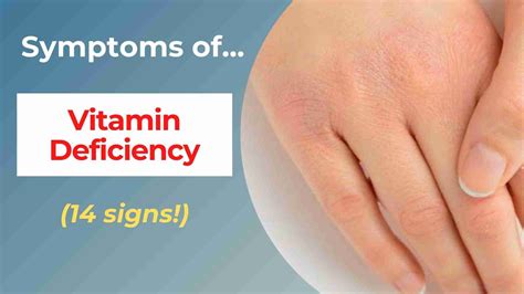 Top 14 Symptoms of Vitamin Deficiency — Eating Enlightenment