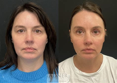 Minimally Invasive Neck Tightening Before and After Pictures Case 228 | Denver, CO | Ladner ...