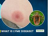 What Is Lyme Disease? Here Are Its Causes, Symptoms, Prevention And ...