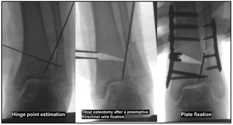 Surgical Correction of Large Talar Tilt in Varus Ankle Osteoarthritis ...