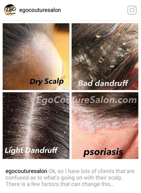 Scalp Dandruff 的图像结果