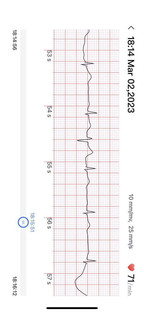 Are Interpolated PVCs dangerous? Why they happening? : r/ReadMyECG