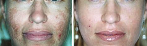 Restorative Oil | Best contact dermatitis, psoriasis treatment oil ...