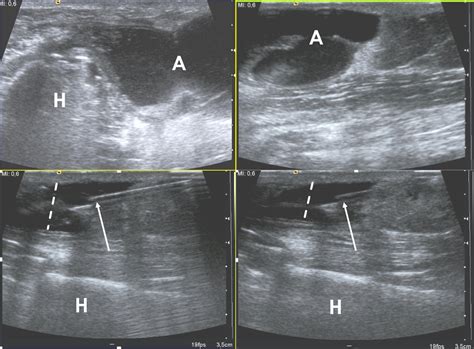 Imaging of Soft-Tissue infections | Encyclopedia MDPI