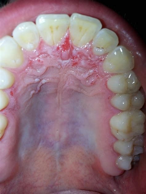 All The Reasons Why The Roof Of Your mouth Hurts