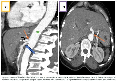 Anatomical Variant at Surgical Risk: Median Arcuate Ligament Syndrome ...