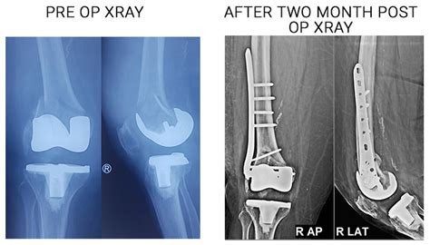 Best Joint Replacement Surgeon in Delhi