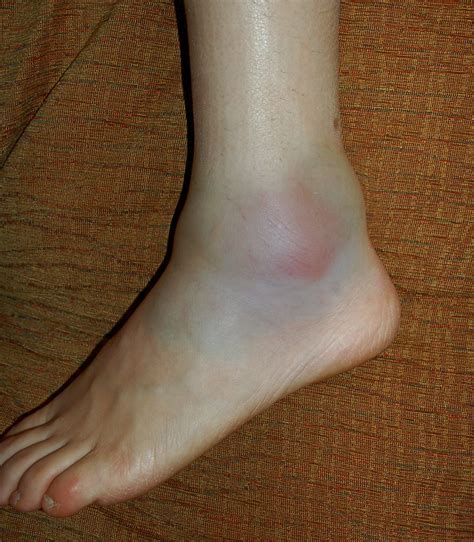 My sprained ankle | Scott Ableman | Flickr