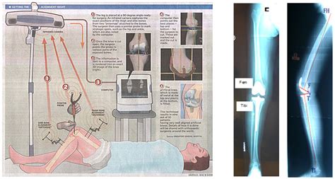 Image result for Computer Assisted Surgery