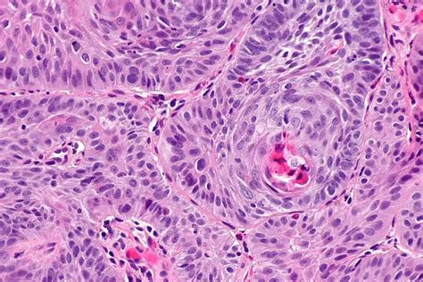 Cancer IV Treatment: 7 Essential IV Chemo Education Sheets You Need