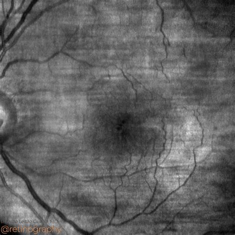 Cystoid Macular Edema – Retinography
