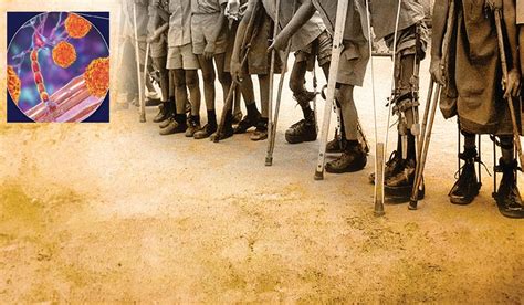 இந்தியாவில் இன்னும் இருக்கிறதா போலியோ? | Does polio still exist in ...