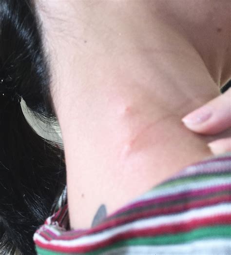 Neck Bite Marks