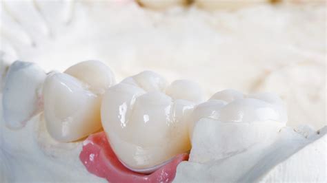 Tooth Crown Cement 的图像结果