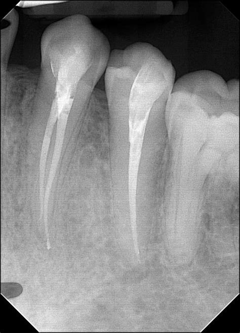 Root Canal