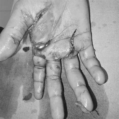 Minor injured while exploding bomb in Kota, video surfaces: Five bones ...