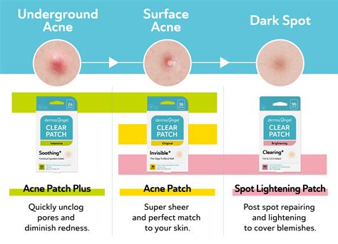 Acne Patch-DermaAngel
