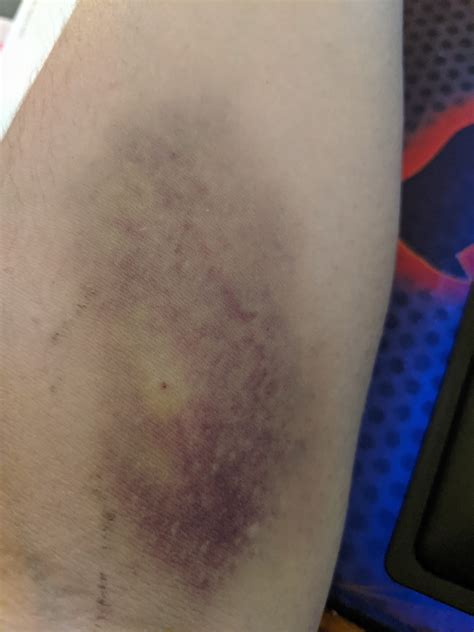 Bruise from IV after she kept adjusting the needle in my vein : r ...