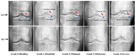KOC_Net: Impact of the Synthetic Minority Over-Sampling Technique with Deep Learning Models for ...