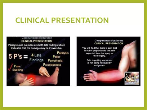COMPARTMENT SYNDROME (2) (1).pptx