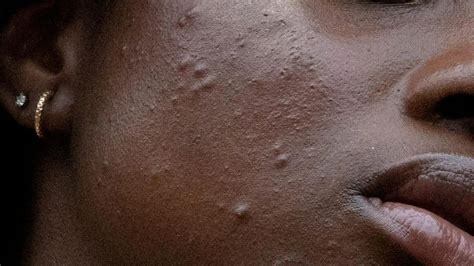 Blackheads On African American Skin