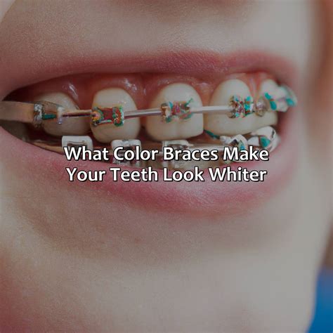 Braces Without Color at Edward Oneal blog