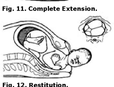 Image result for Common Compensatory Pattern