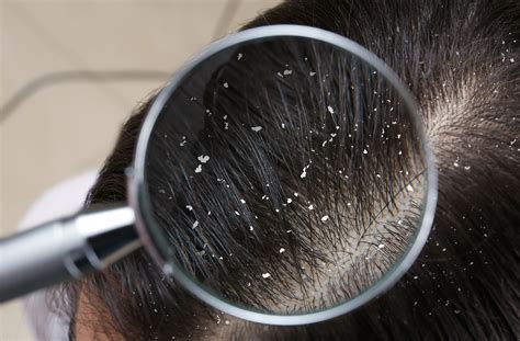 Hair Dandruff And Hair Loss