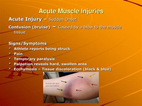 PPT - Mechanism of Injuries PowerPoint Presentation, free download - ID:9173378