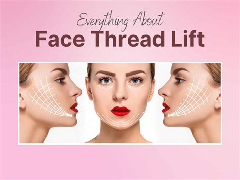 What Is A Face Thread Lift at Shelia Meyer blog
