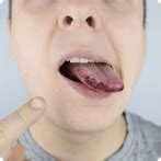 Black Spots On the Tongue: Symptoms, Causes, and Treatment