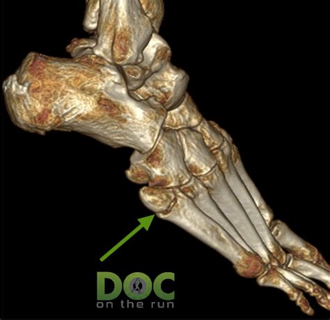 Pseudo Jones Fracture