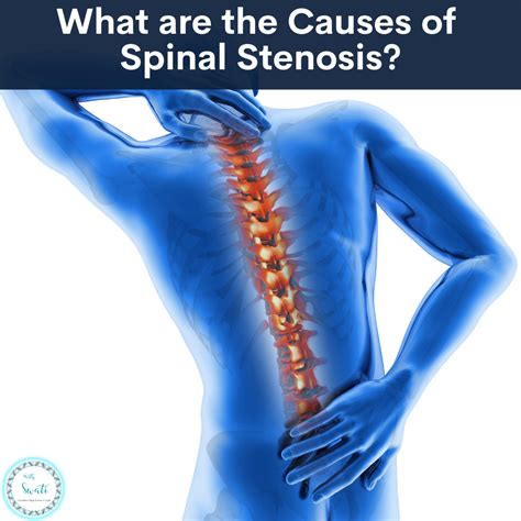 What are the Causes of Spinal Stenosis? | Swati Prakash
