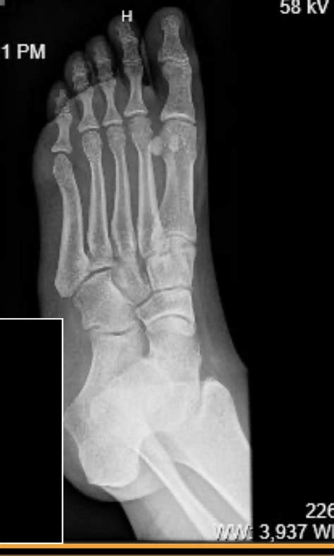 Any signs of a small fracture? Hairline? Been hurting for six weeks now ...