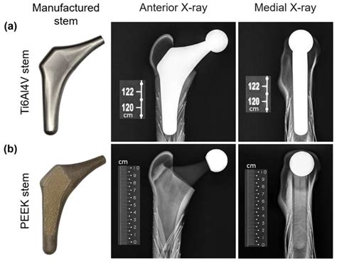 Stress Shielding and Bone Resorption of Press-Fit Polyether–Ether–Ketone (PEEK) Hip Prosthesis ...