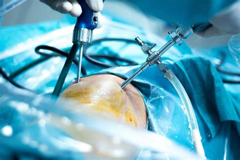 Scoping The Knee Surgery